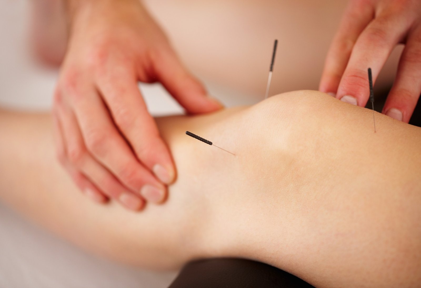 acupuntura-ayuda-dolor-muscular